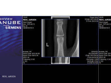 Doch selbst mein schwächster Finger, der Kleinfinger, zeigt in einem aktuellen Röntgenbild knöcherne „Verstärkungen“ im Gelenksbereich.