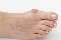 Hallux valgus, der Schiefstand des Großzehs: Symptome, Behandlung, Diagnose