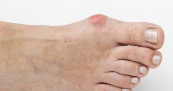 Hallux valgus und andere Fehlstellungen der Füße Hallux valgus, der Schiefstand des Großzehs: Symptome, Behandlung, Diagnose