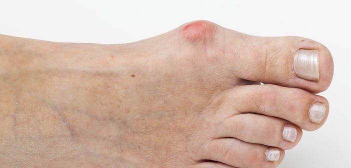 Hallux valgus, der Schiefstand des Großzehs: Symptome, Behandlung, Diagnose