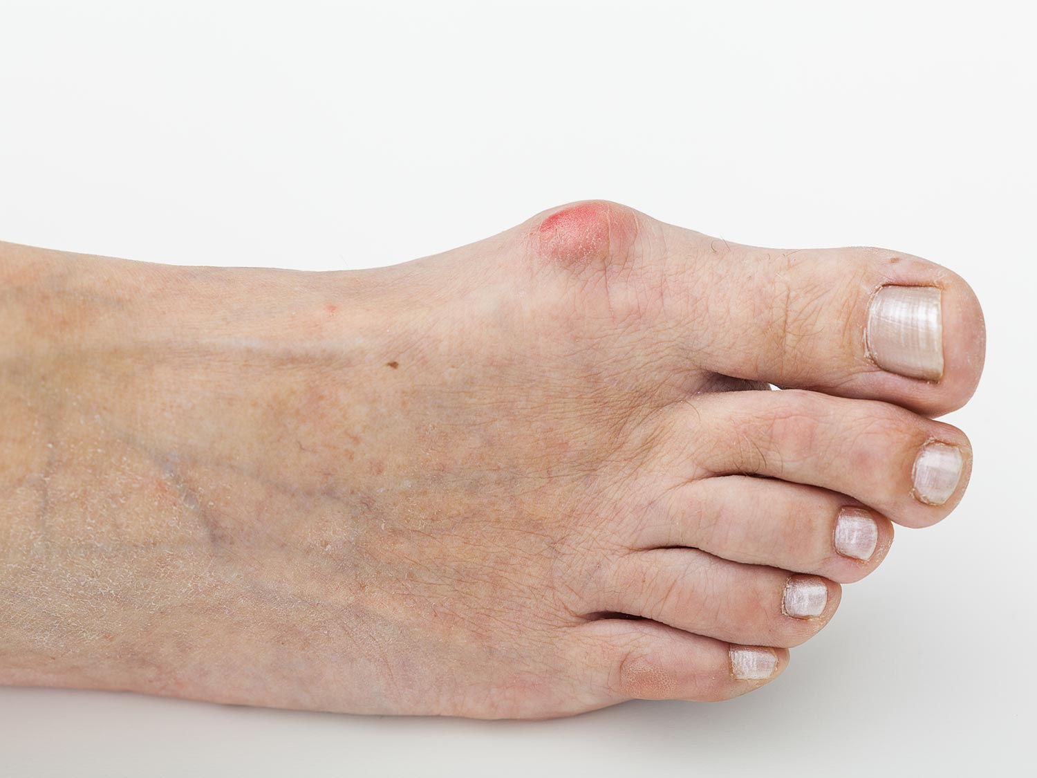 Hallux valgus Schiefstand des Großzehs und Fehlstellungen der Füße