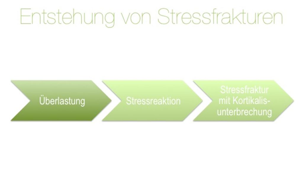 Entstehung der Stressfraktur: Überlastung -> Stressreaktion -> Stressfraktur mit Kortikalisunterbrechung