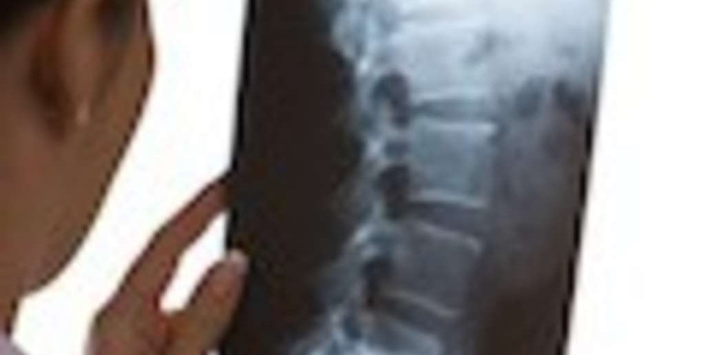 Altersbedingte Veränderungen der Wirbelsäule