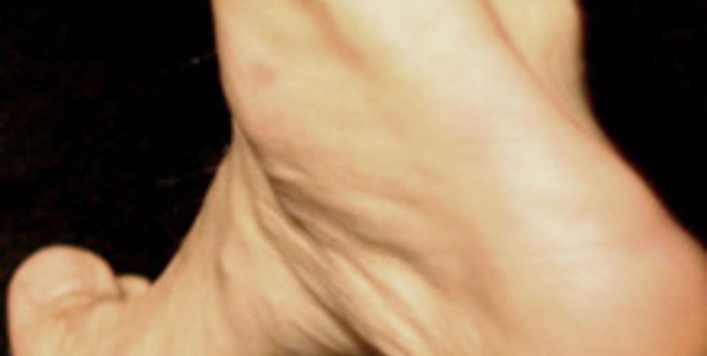 Fußverletzungen und wie Sie diese vermeiden können