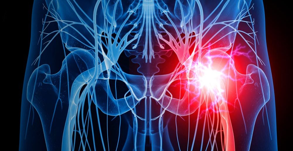 Piriformis-Syndrom und Ischias