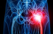 Piriformis-Syndrom und Ischias
