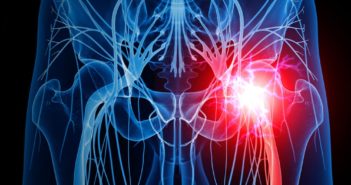 Der Umgang mit dem Piriformis-Syndrom und Ischiasbeschwerden Piriformis-Syndrom und Ischias