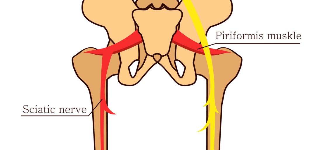 Das Piriformis-Syndrom: Starke Schmerzen in Gesäß, Beinen und Rücken