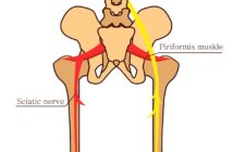 Das Piriformis-Syndrom: Starke Schmerzen in Gesäß, Beinen und Rücken