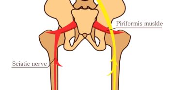 Was ist das Piriformis-Syndrom? Das Piriformis-Syndrom: Starke Schmerzen in Gesäß, Beinen und Rücken
