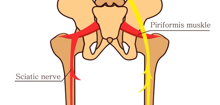 Das Piriformis-Syndrom: Starke Schmerzen in Gesäß, Beinen und Rücken
