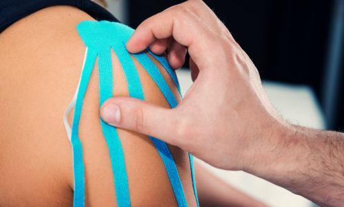 was ist das Impingement-syndrom? Ratgeber und Erklärungen