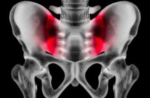 Iliosakralgelenk-Blockade, Rückenschmerzen, Piriformis-Syndrom