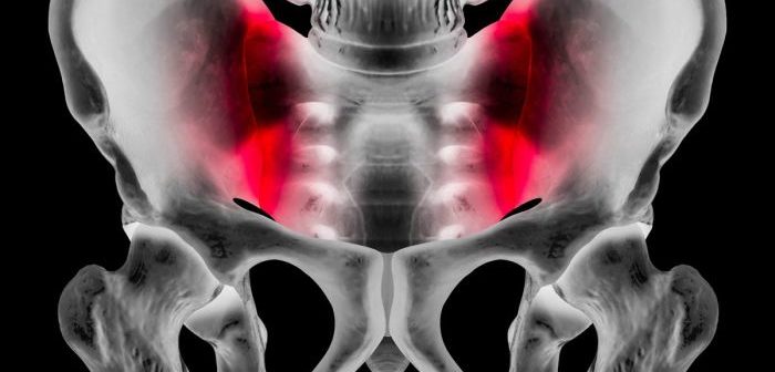 Iliosakralgelenk-Blockade, Rückenschmerzen, Piriformis-Syndrom