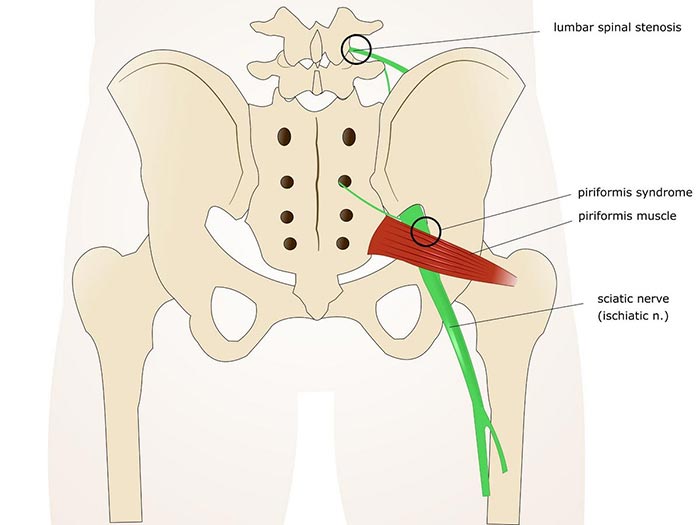 Das Piriformis Syndrom - starke Schmerzen in Gesäß, Beinen und Rücken