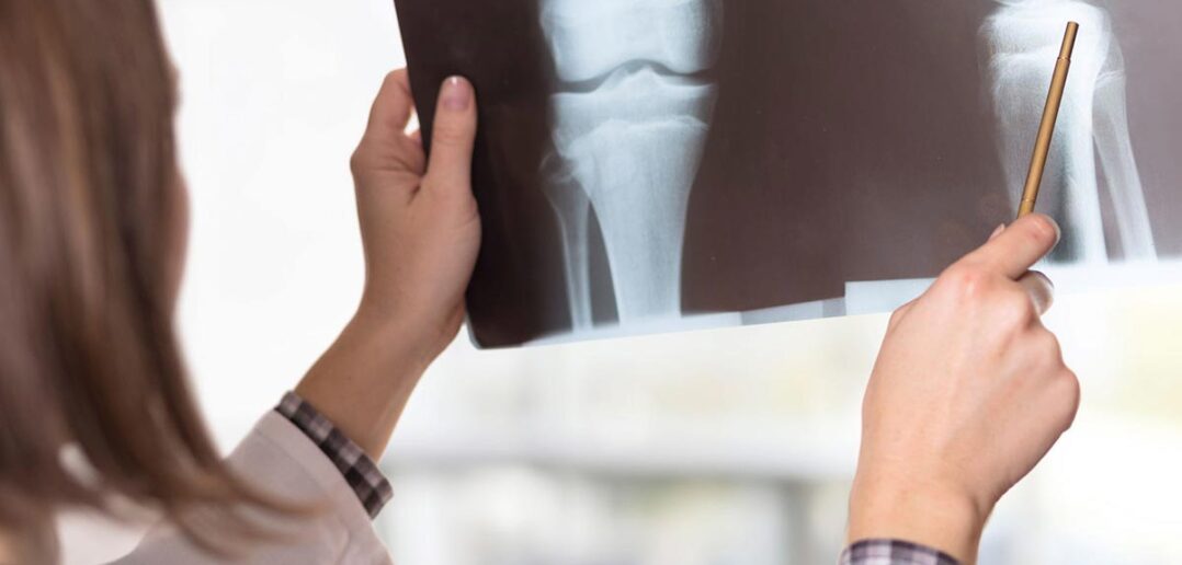 laufverletzung, kreuzband, Beinachsen