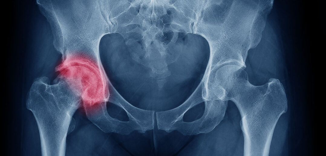 ratgeber: was kannn man gegen hüftarthrose tun?
