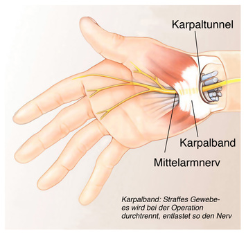 Karpalband, straffes Gewebe-es wird bei der Operation durchtrennt, entlastet so den Nerv