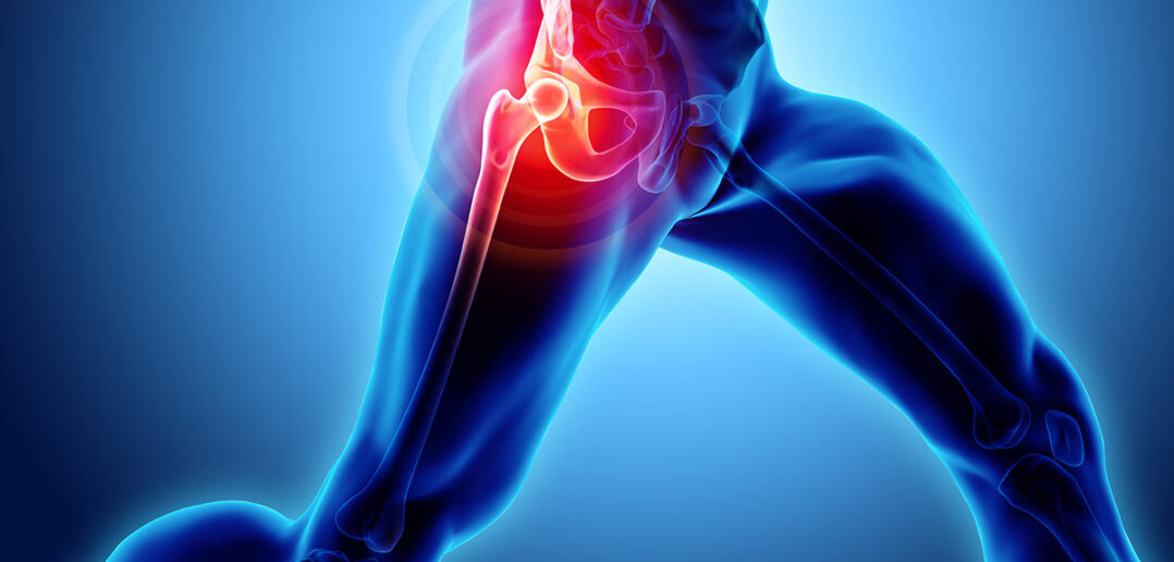 Die besten Hüftübungen für mehr Beweglichkeit Hüftschmerzen treten häufig im Alter auf. Dagegen helfen die richtigen Übungen zur Kräftigung der hüftumgebenden Muskulatur.