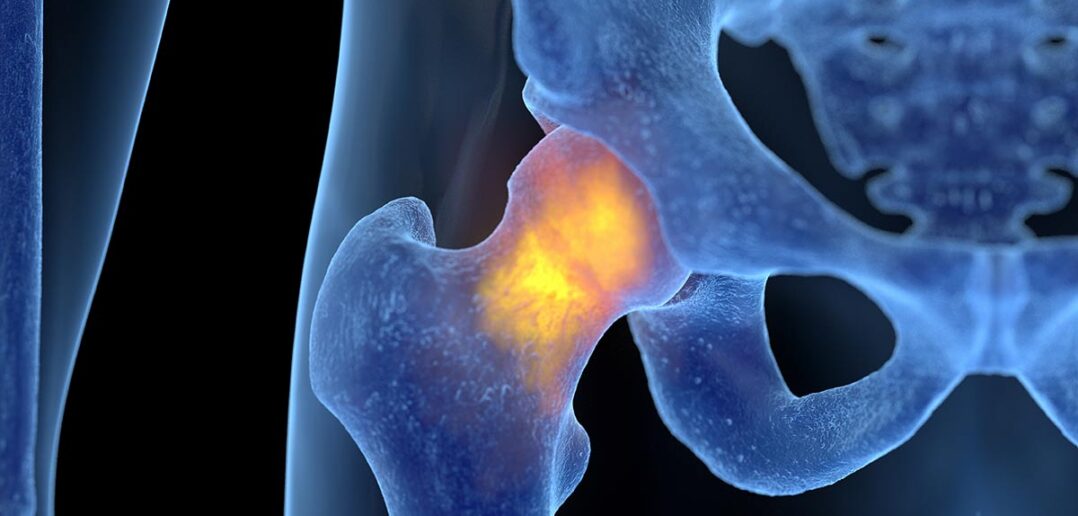 Eine Hüftprothese wird eingesetzt, wenn konservative Arthrosebehandlungen nicht helfen