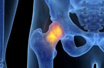 Eine Hüftprothese wird eingesetzt, wenn konservative Arthrosebehandlungen nicht helfen