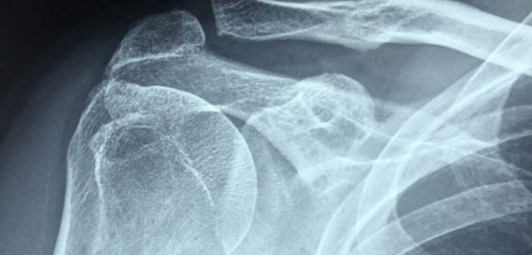 Osteoporose ohne Medikamente behandeln